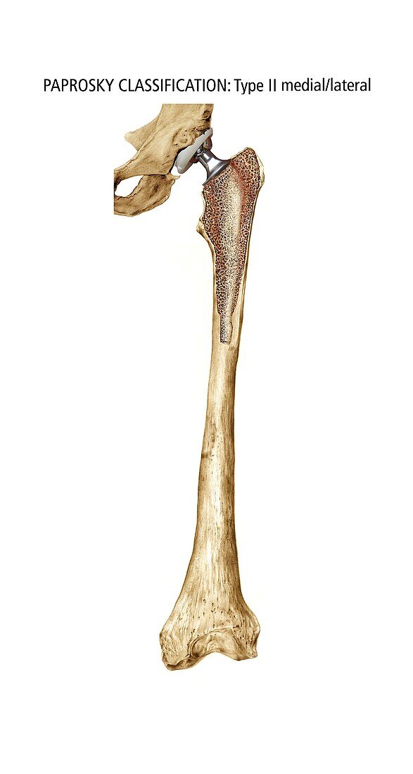 Paprosky femur defect,type II med-lat