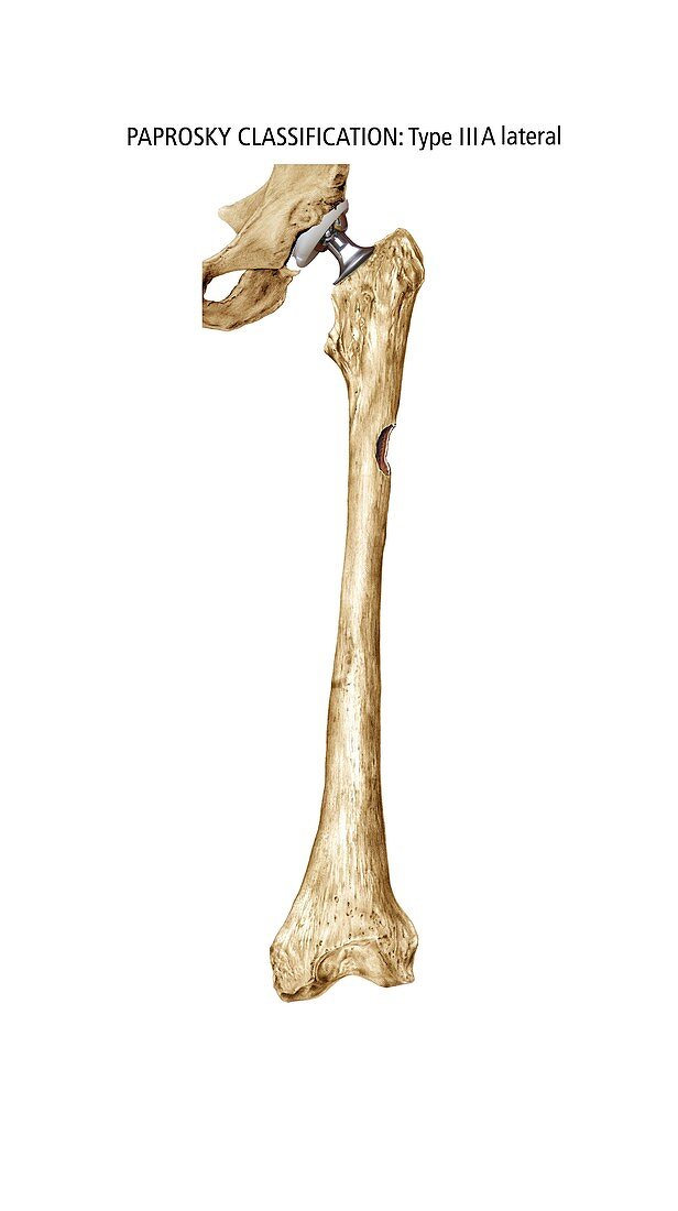 Paprosky femur defect,type IIIA lateral