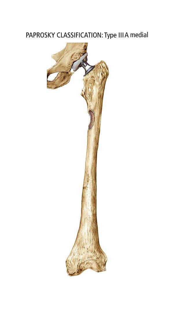 Paprosky femur defect,type IIIA medial