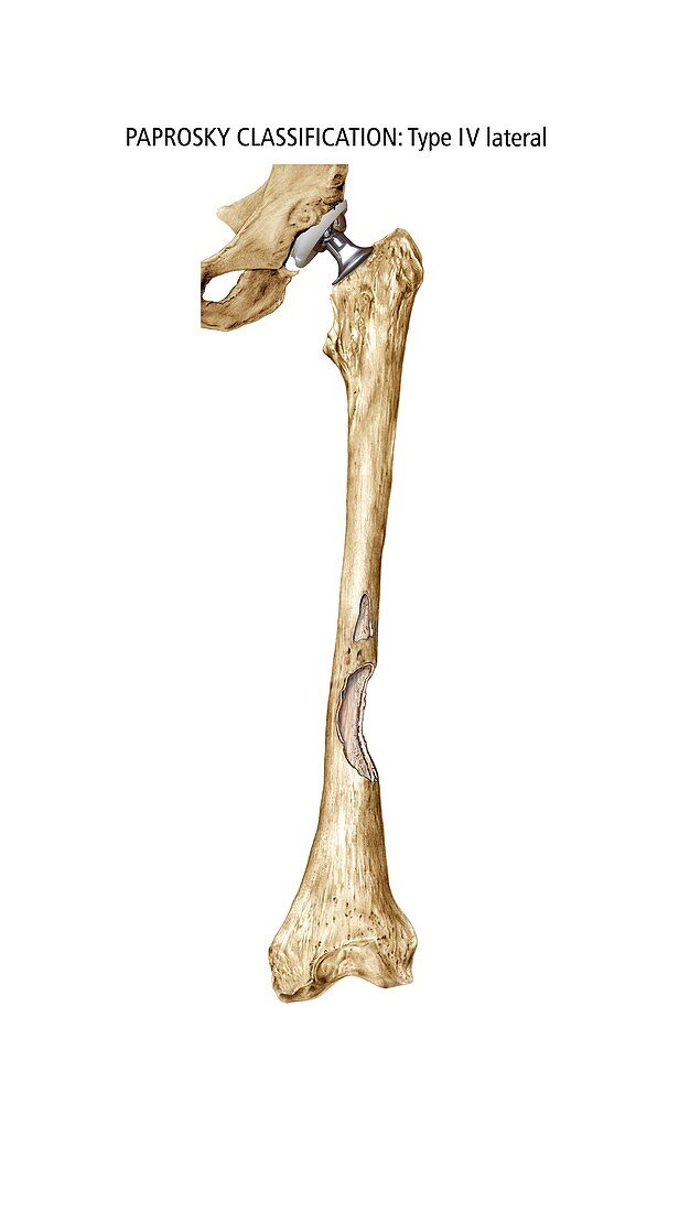Paprosky femur defect,type IV lateral