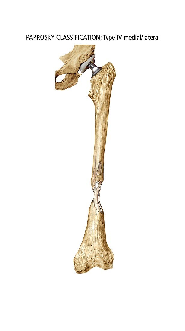 Paprosky femur defect,type IV med-lat