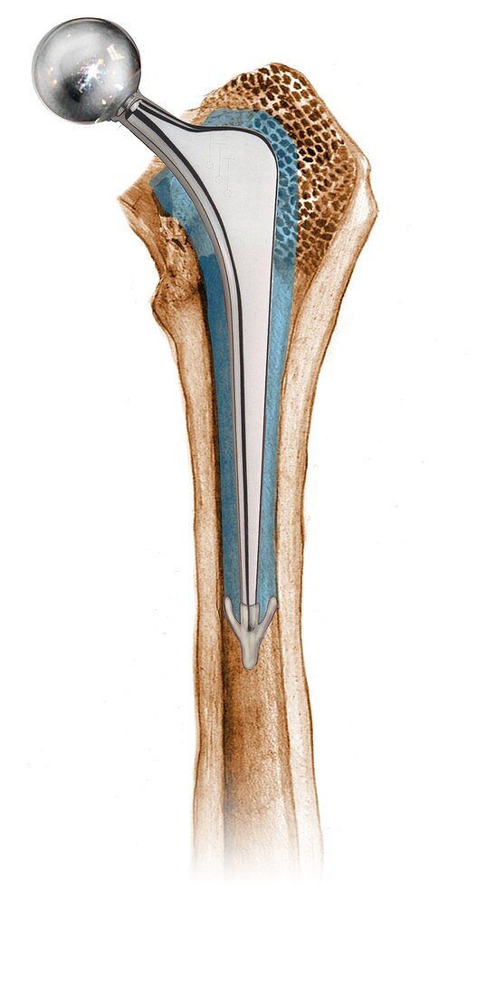 Prosthetic hip joint,artwork