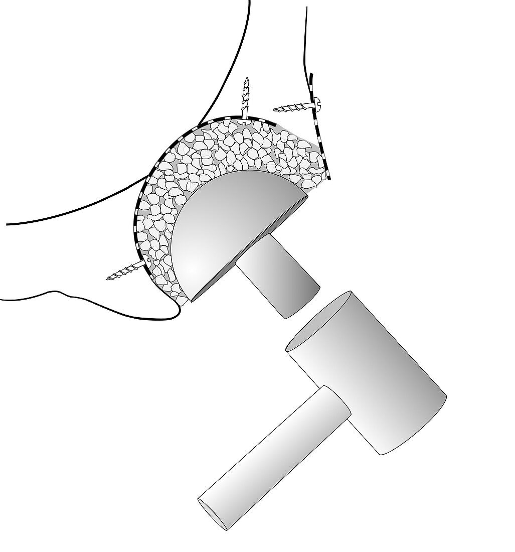 Hip socket bone grafting,diagram