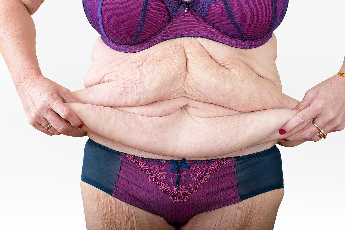 Woman with excess skin after weight loss