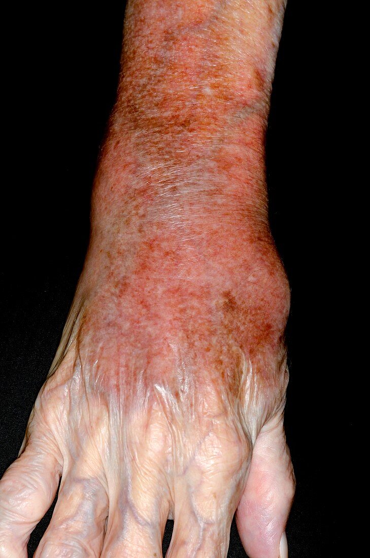 Cellulitis of the wrist