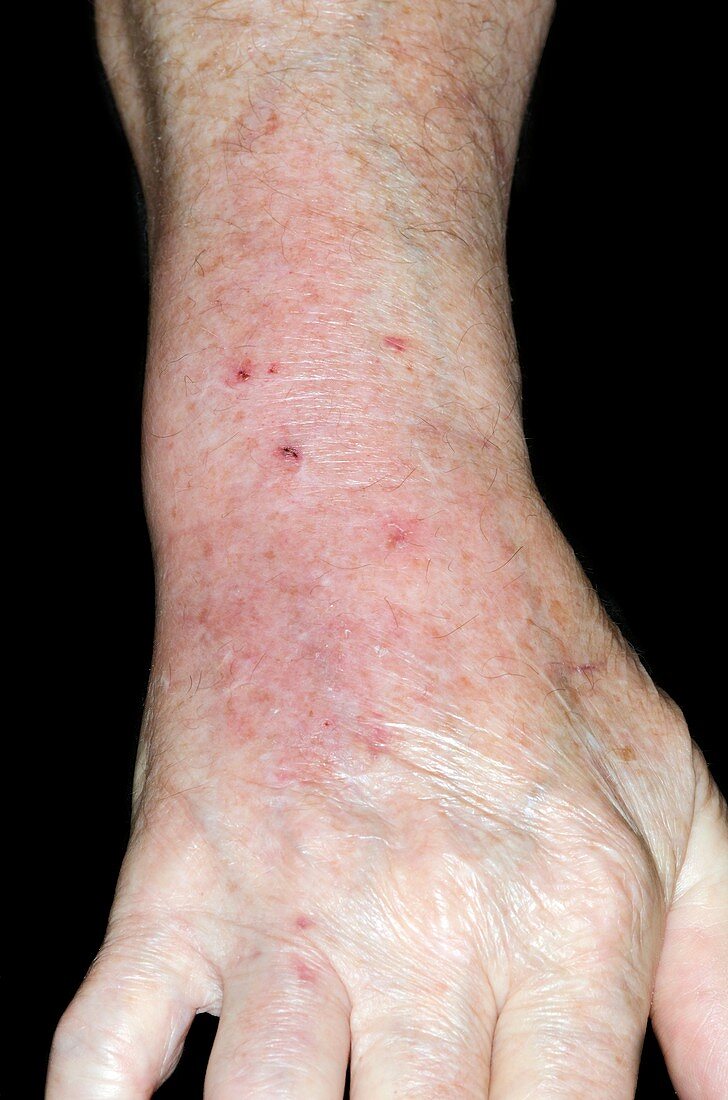 Infected cat bite on the wrist