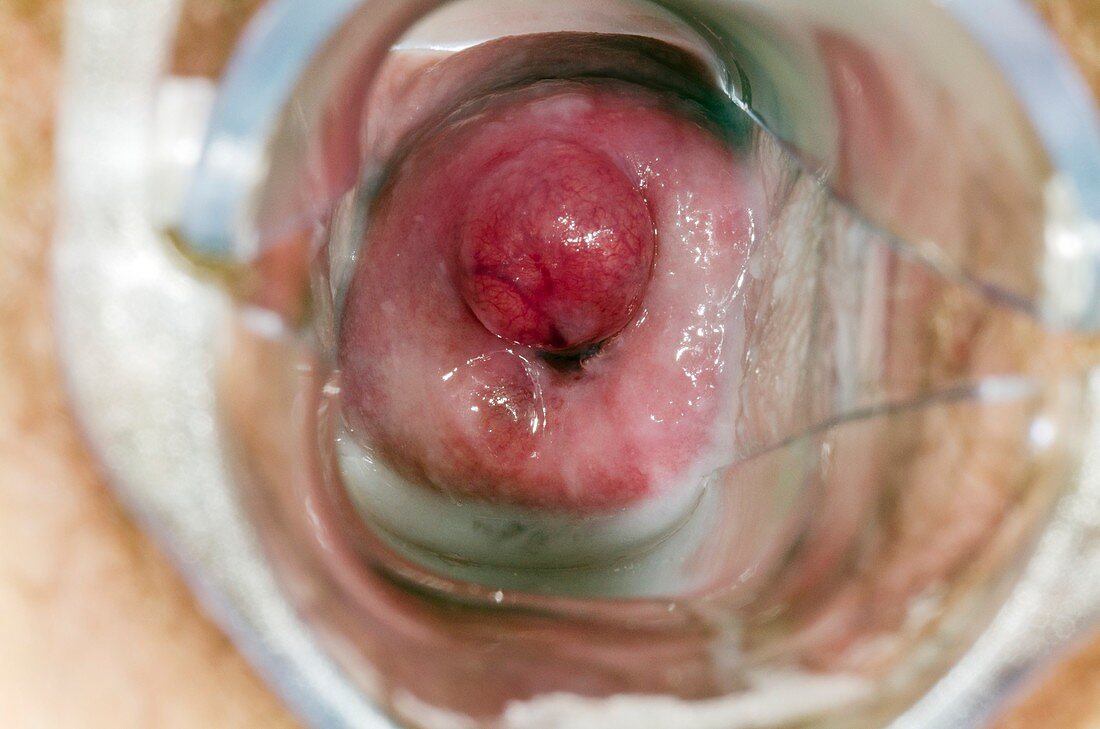 Nabothian cyst on the cervix