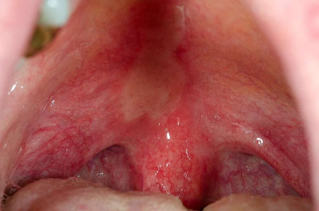 Ulcer on palate of the mouth