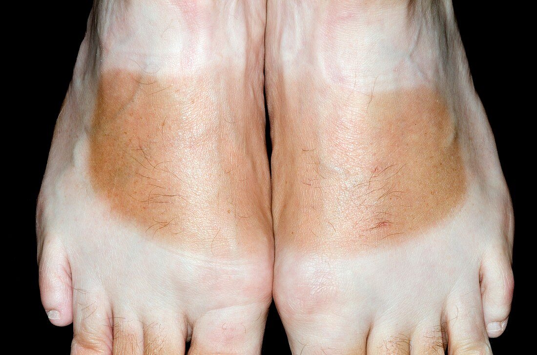 Sunburned feet
