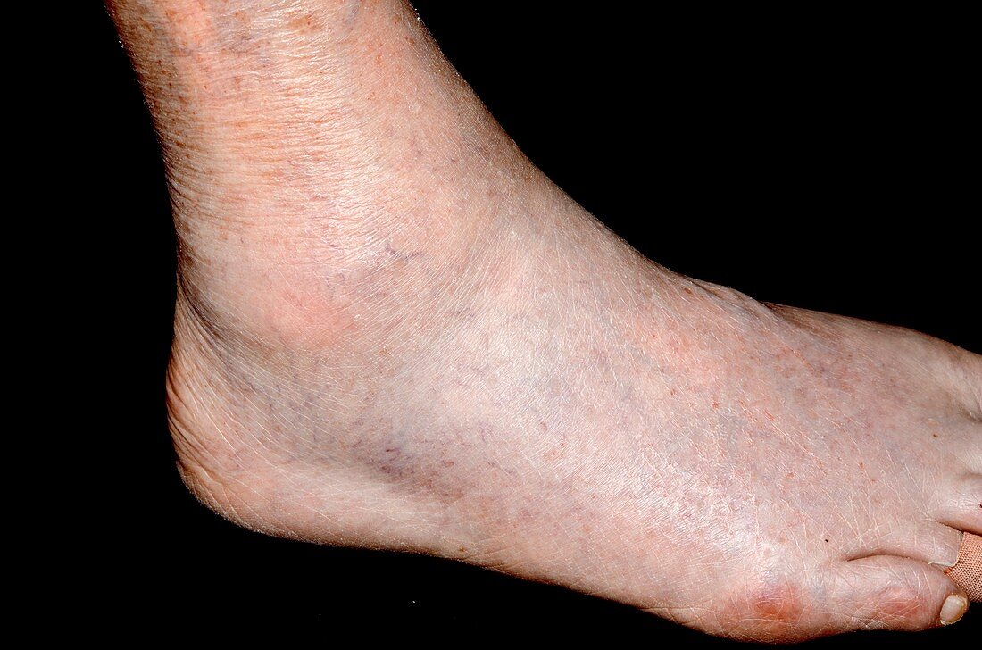 Gout in the ankle