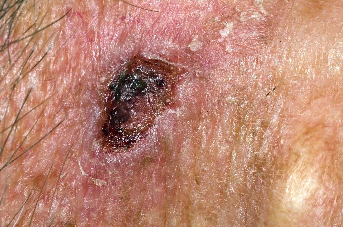 Basal cell skin cancer behind the ear