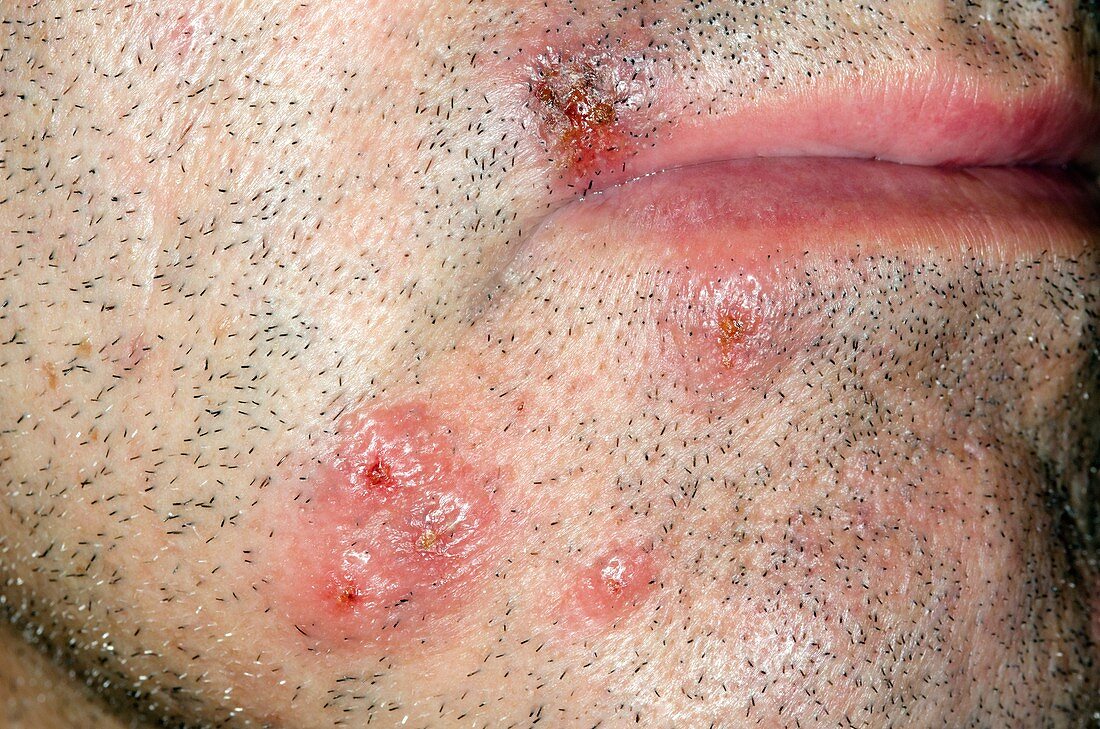 Cold sores around the mouth