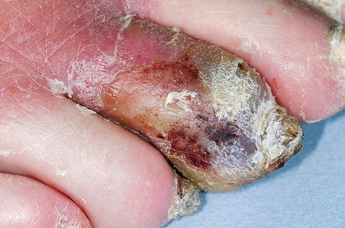 Toe infection in a diabetic