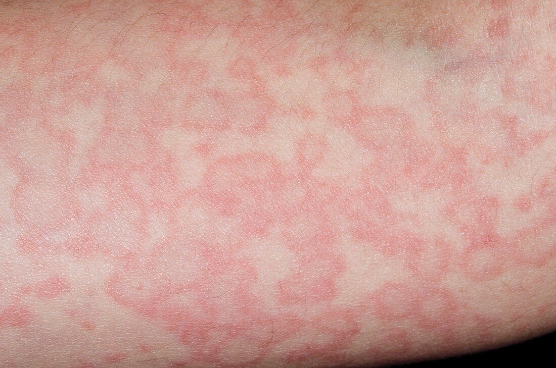Urticaria reaction to viral infection
