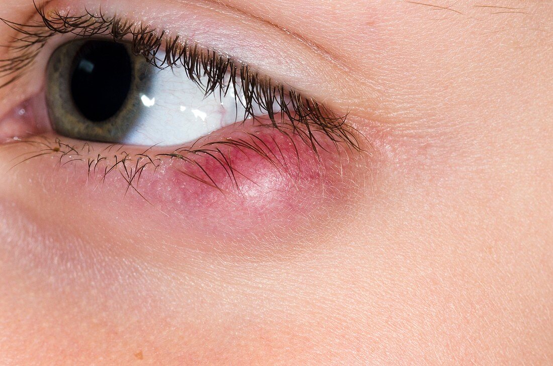 Meibomian cyst in the lower eyelid
