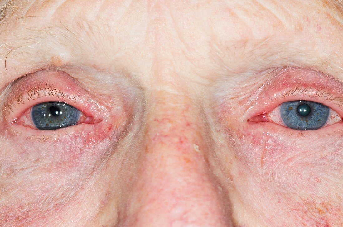 Allergic conjunctivitis