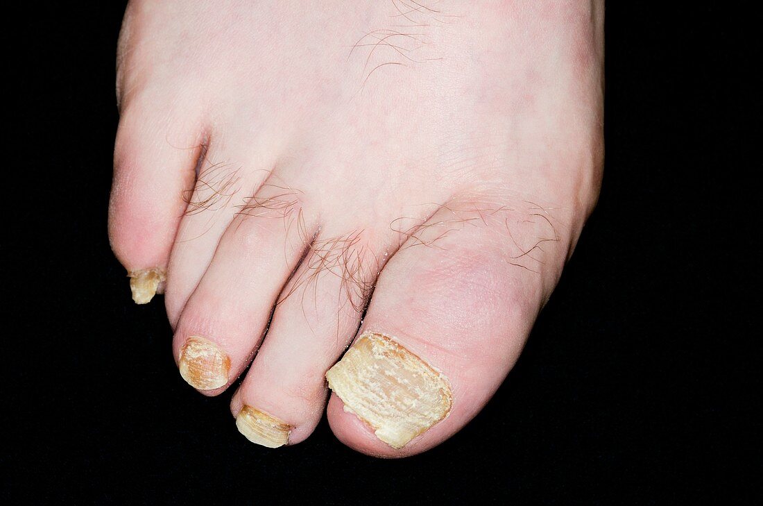 Psoriasis of the toenails