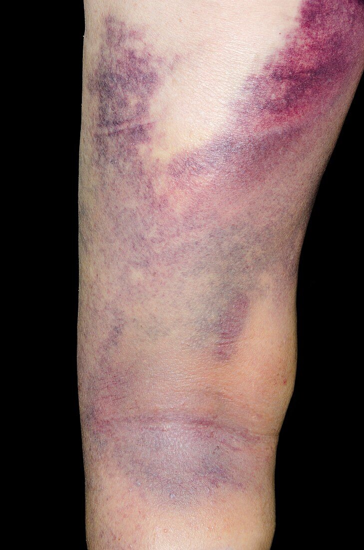 Leg bruising in warfarin patient