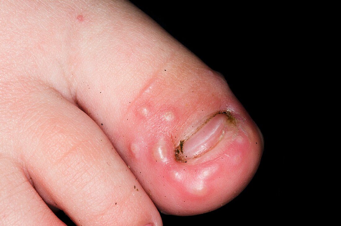Chicken pox on the big toe