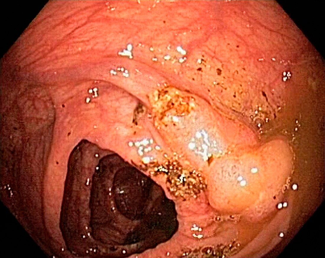 Colon cancer,endoscopic view