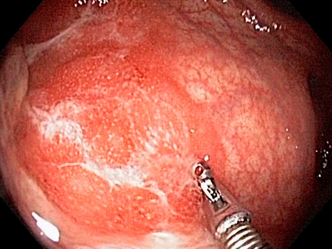 Ulcerative proctitis,endoscopic view