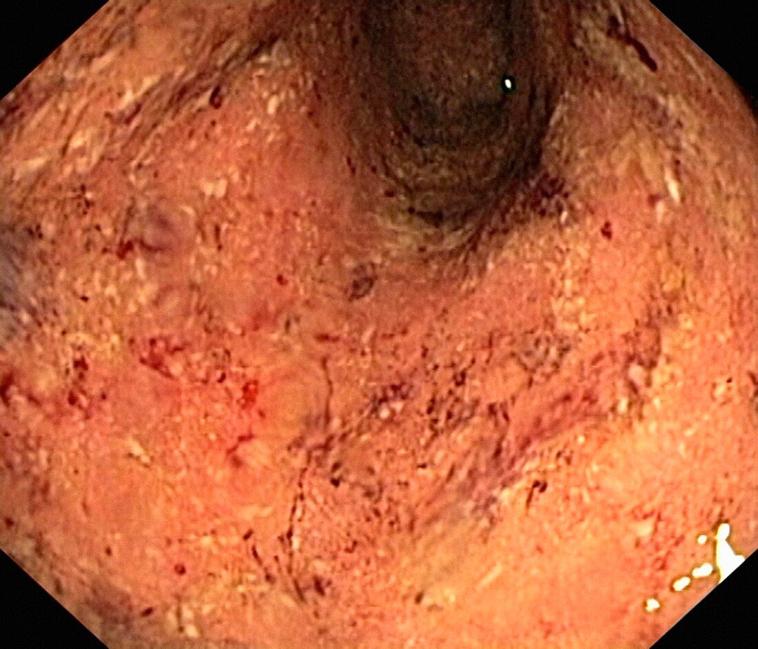 Ulcerative colitis,endoscopic view