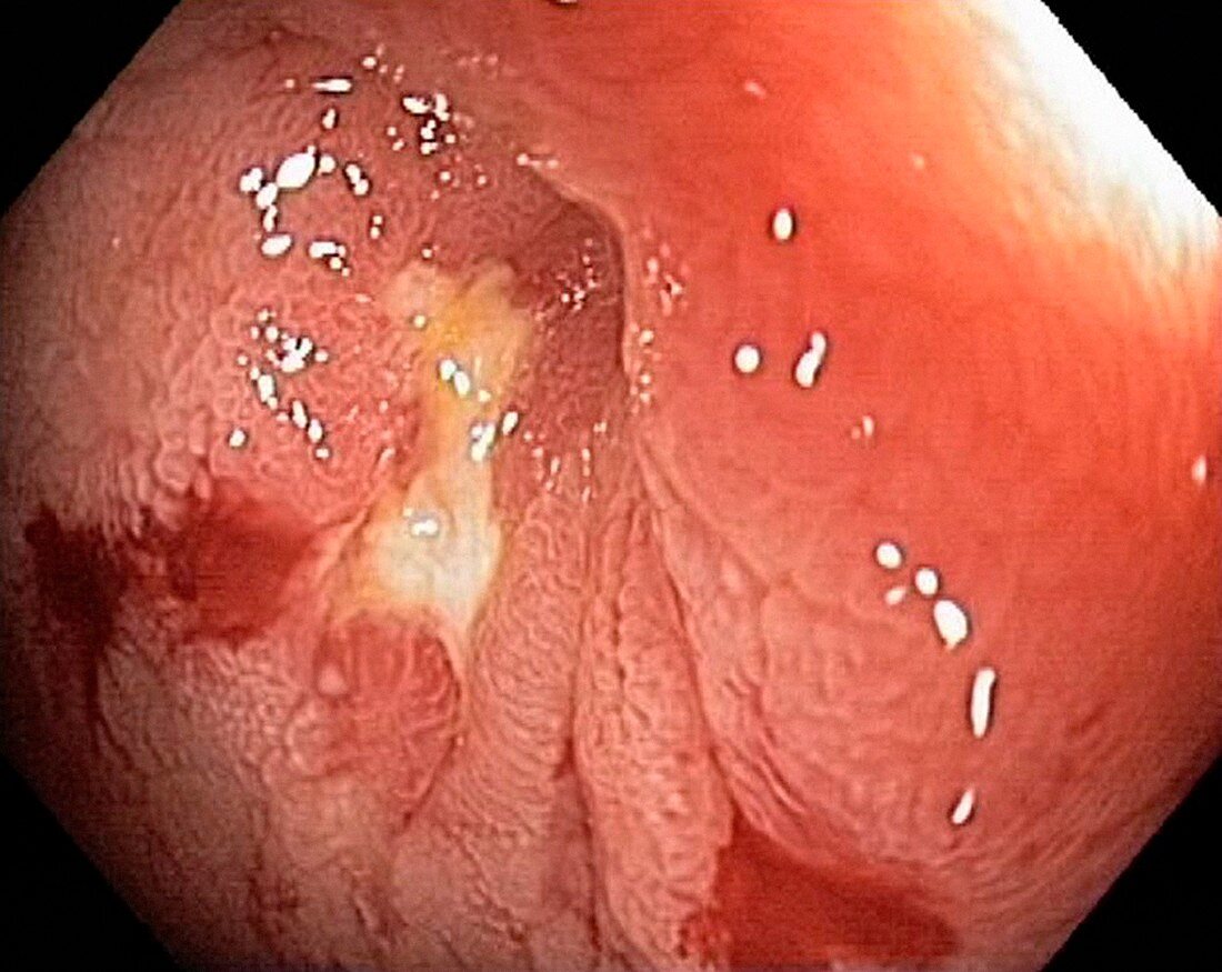 Crohn's disease,endoscopic view