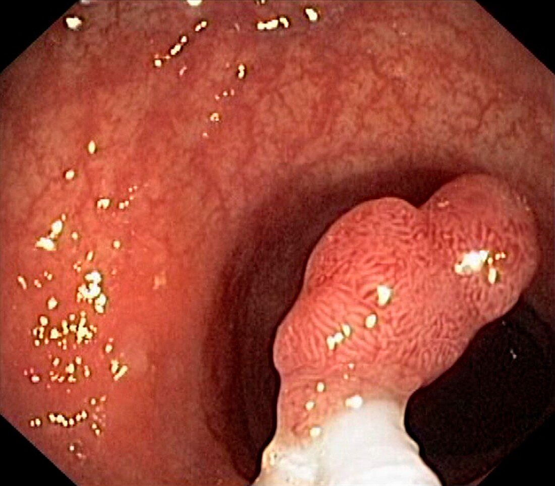 Intestinal polyp removal,endoscopic view