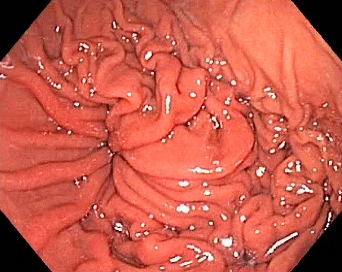 Hiatal hernia,endoscopic view
