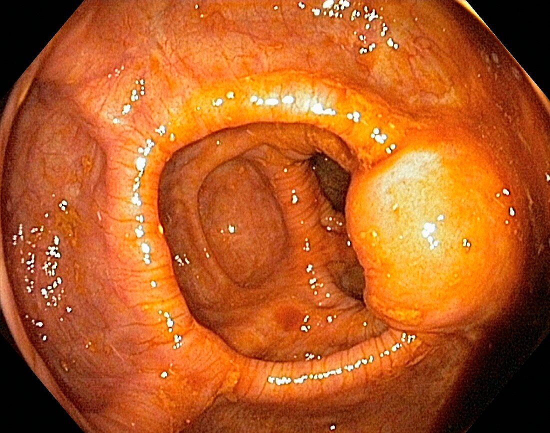 Intestinal lipoma,endoscopic view