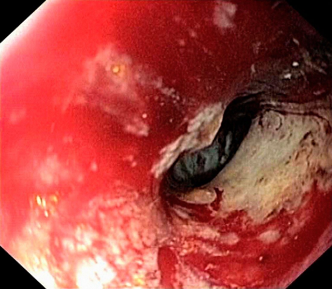 Secondary bowel cancer,endoscopic view