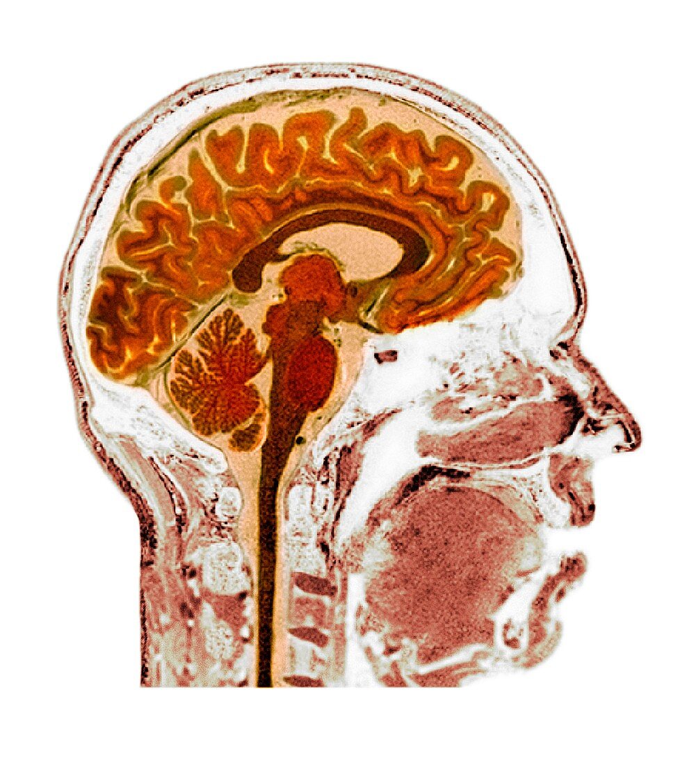 Normal human brain,MRI scan