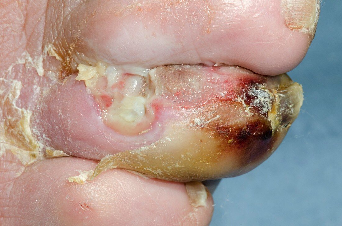 Necrotic infected toe in diabetes