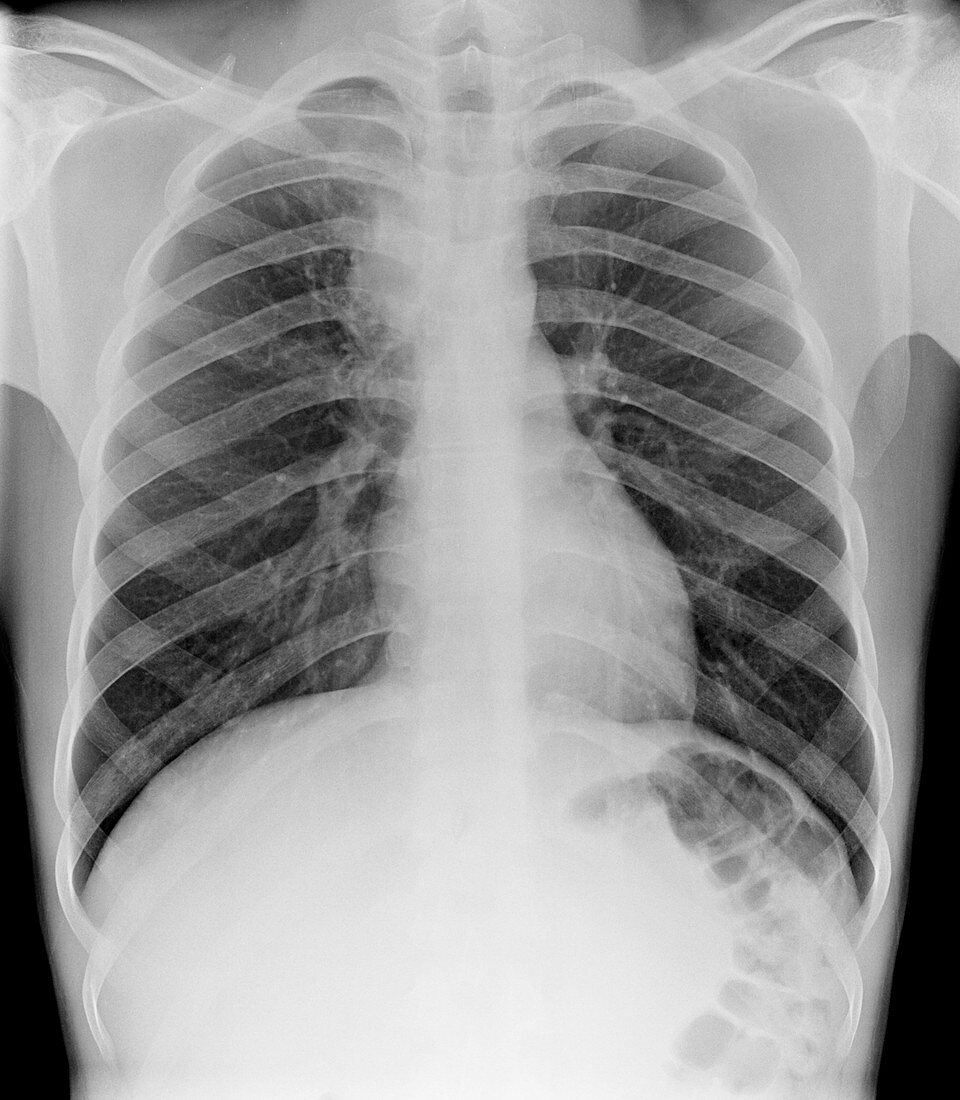 Tuberculosis,chest X-ray