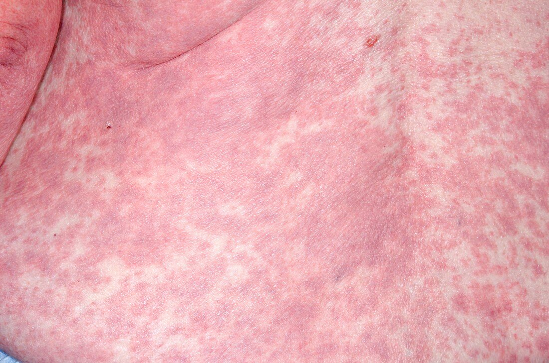 Skin rash after general anaesthetic