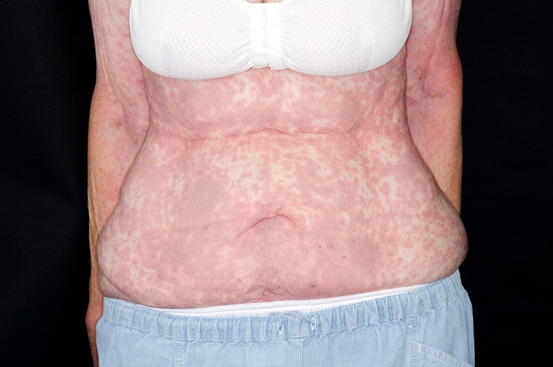 Skin rash after general anaesthetic