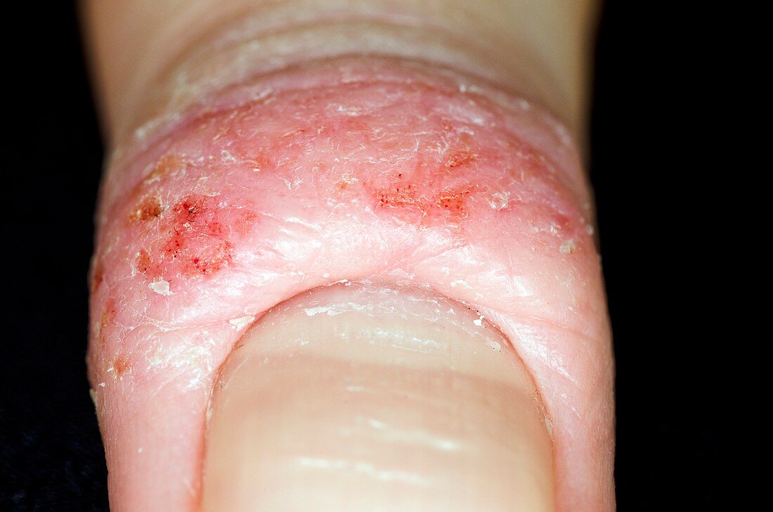 Atopic eczema on the finger