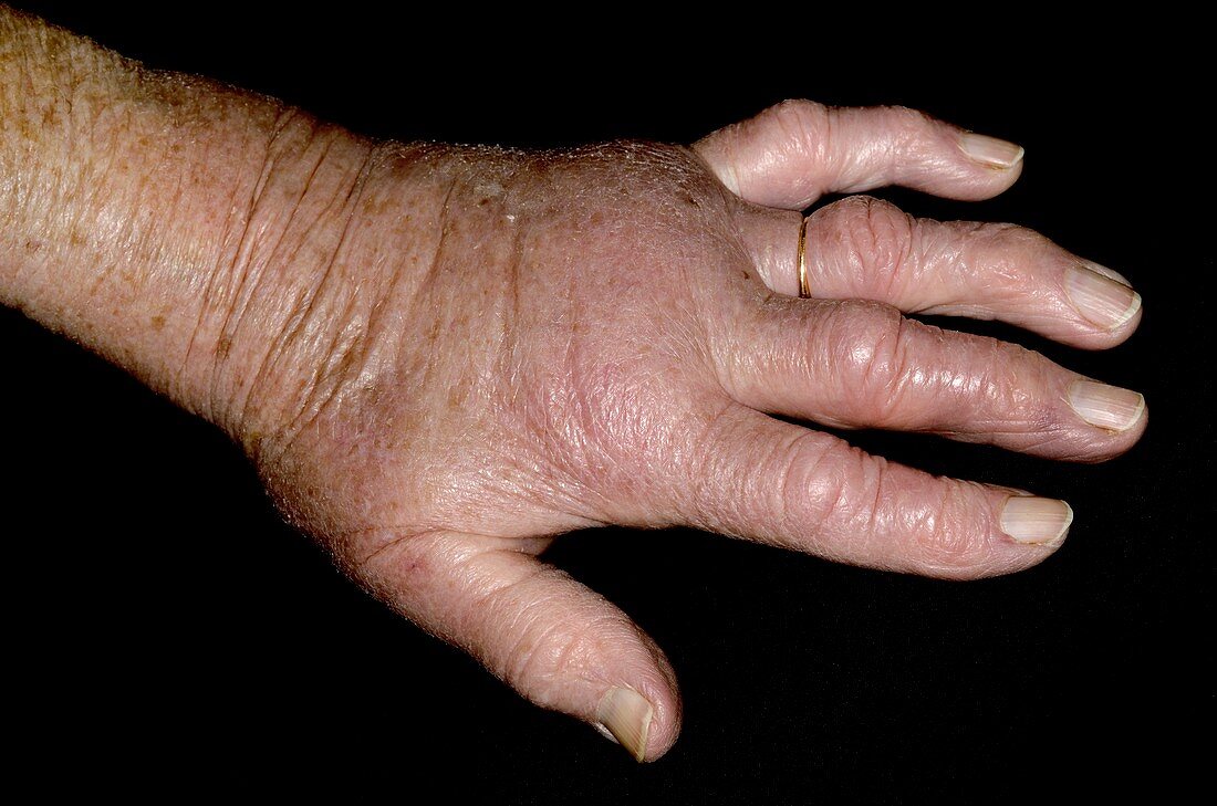 Swollen hand from insect bite