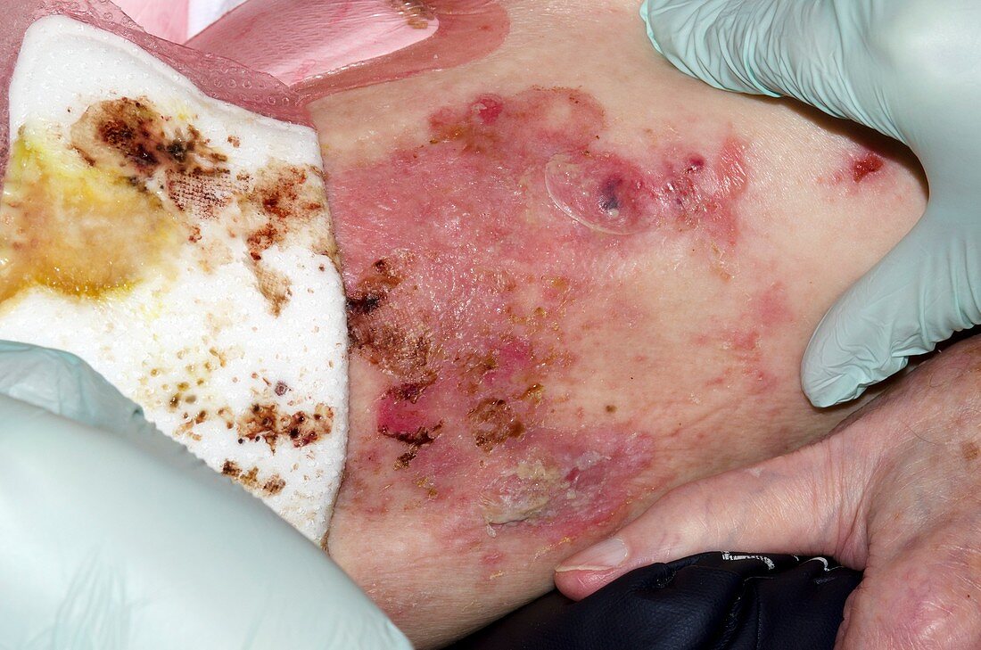 Pemphigoid blisters