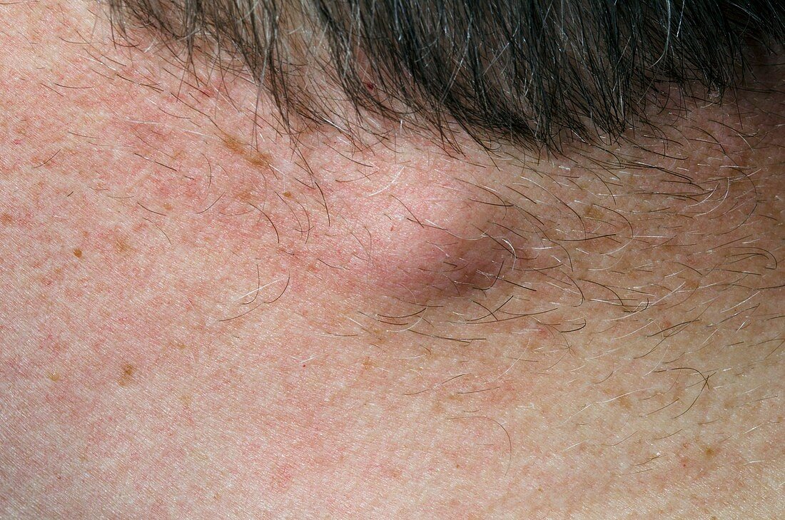 Sebaceous cyst on the neck