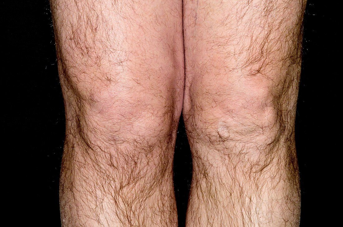 Knee swelling in chondromalacia
