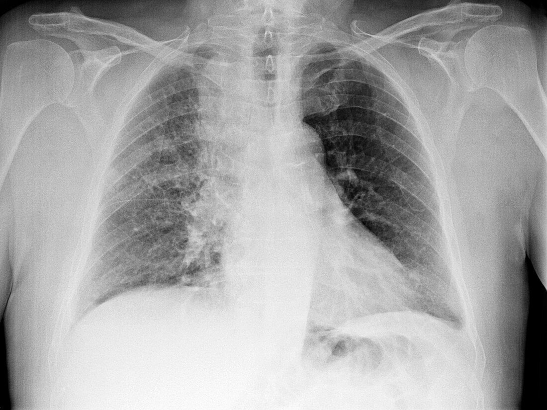 Lung cancer,X-ray