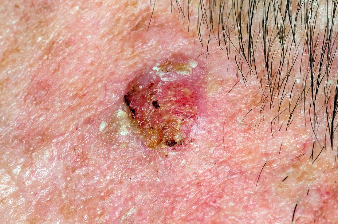 Squamous cell skin cancer