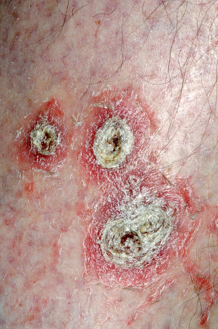Psoriasis on the skin