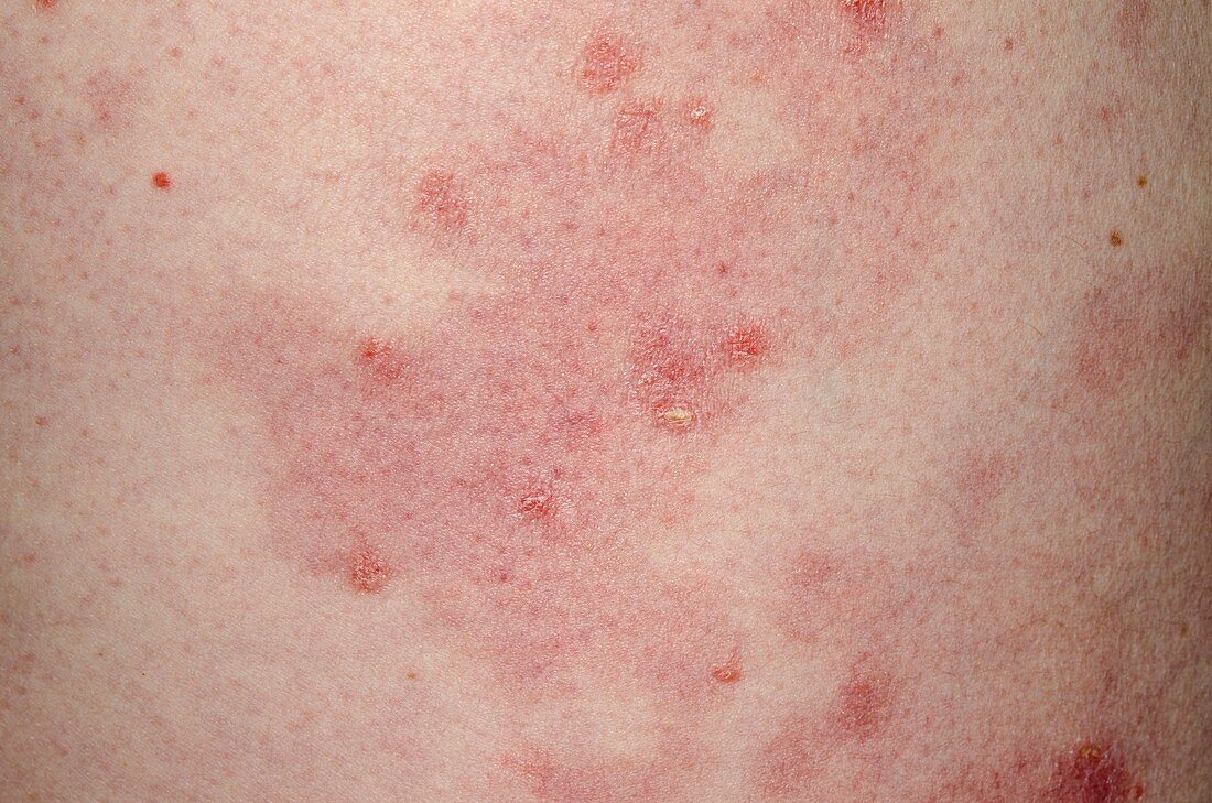 Psoriasis on the skin after lithium