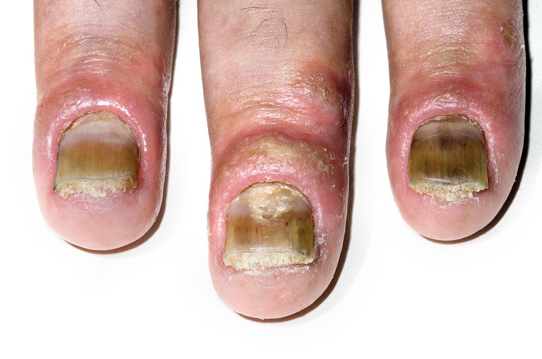 Psoriasis of the fingernails