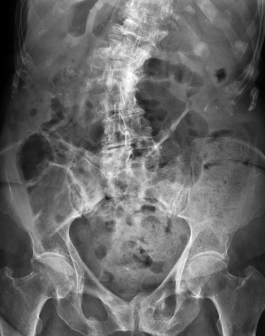 Spinal curvature,X-ray