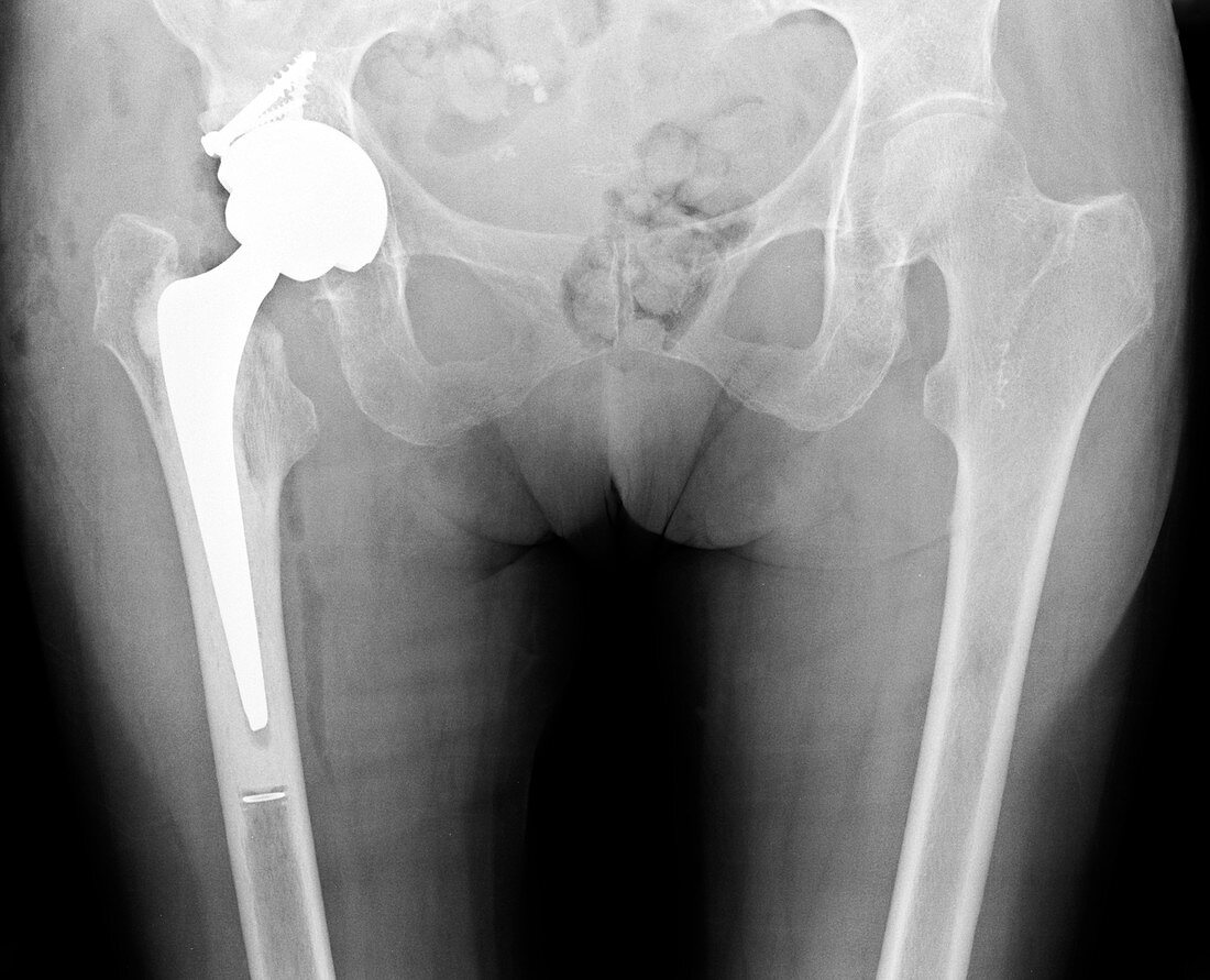 Total hip replacement,X-ray