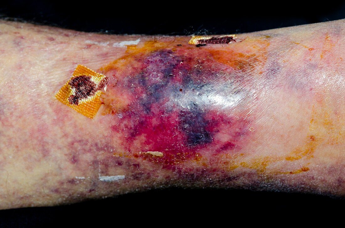 Leg bruising in warfarin patient