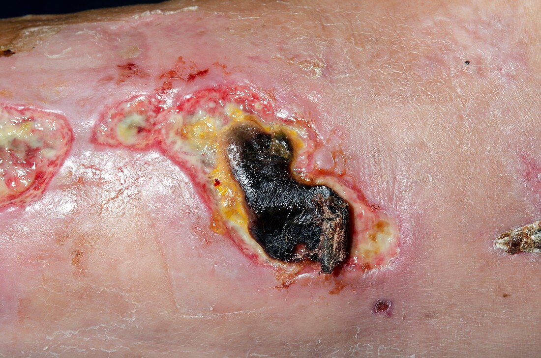 Wound infection after major trauma